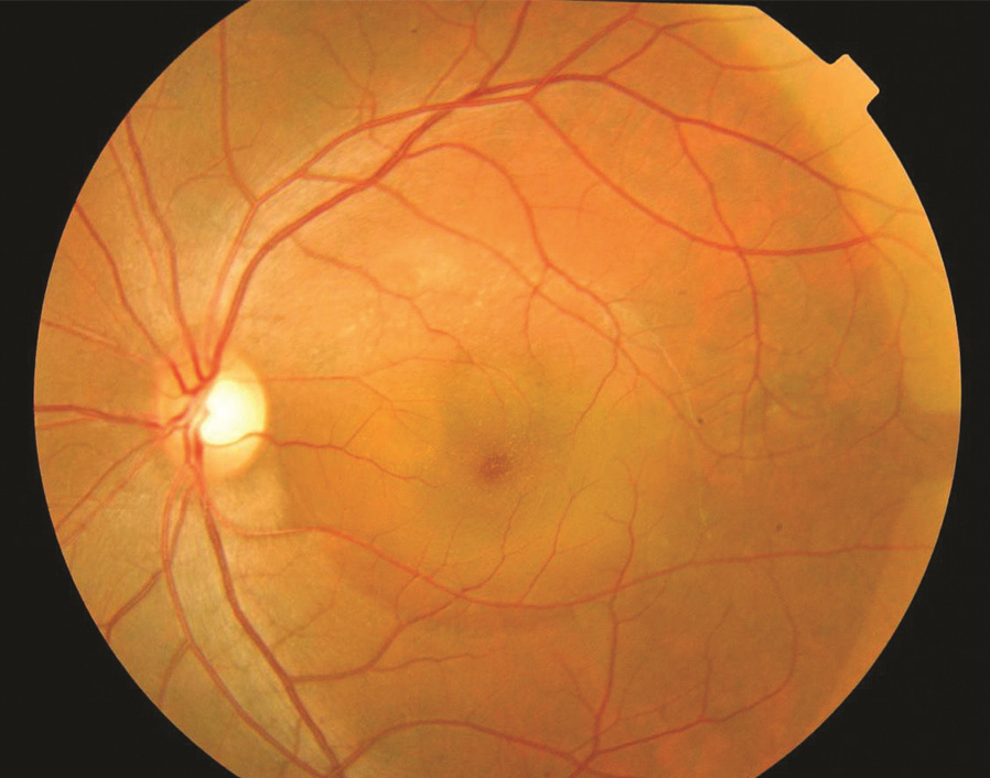 Santral Seröz Retinopati Tedavi Yöntemleri