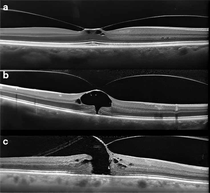 Vitreomaküler Traksiyon Ameliyatı Nasıl Yapılır?