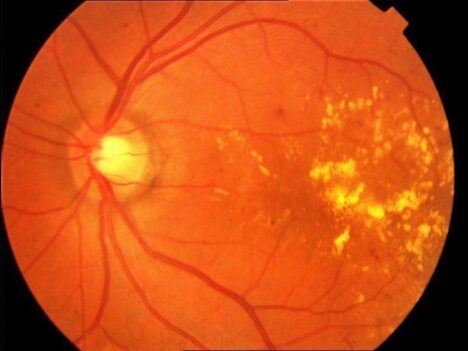 Diyabetik Retinopati Tedavisi