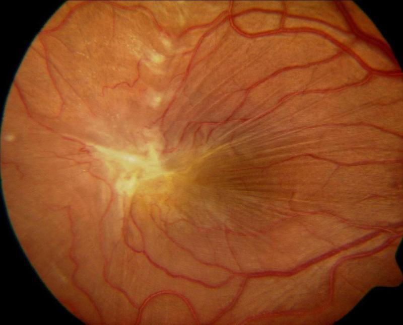 Epiretinal Membran Tedavisi Nasıl Yapılır?