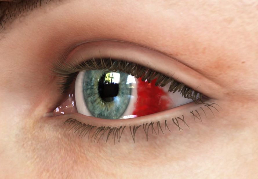 Göz içi Kanamaları Tedavisi Filiz Afrashi - İzmir