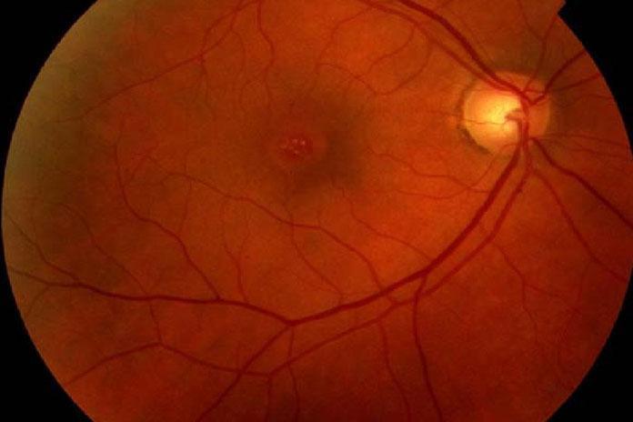 Makula Deliği Tedavisi İzmir - Prof. Dr. Filiz Afrashi