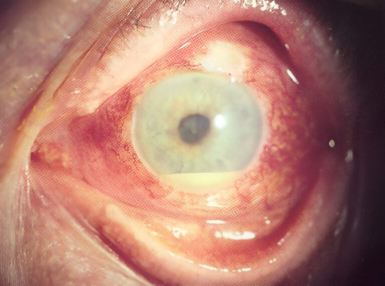 Ön üveit tedavisi izmir