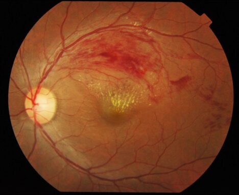Retina damar tıkanıklığı
