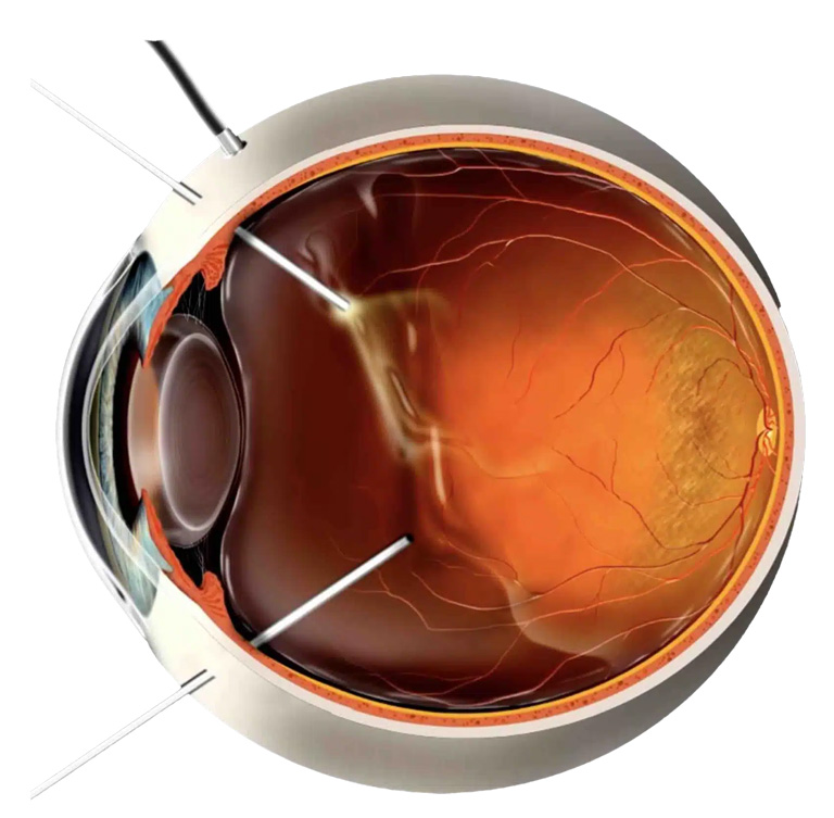 Vitrektomi Ameliyatı